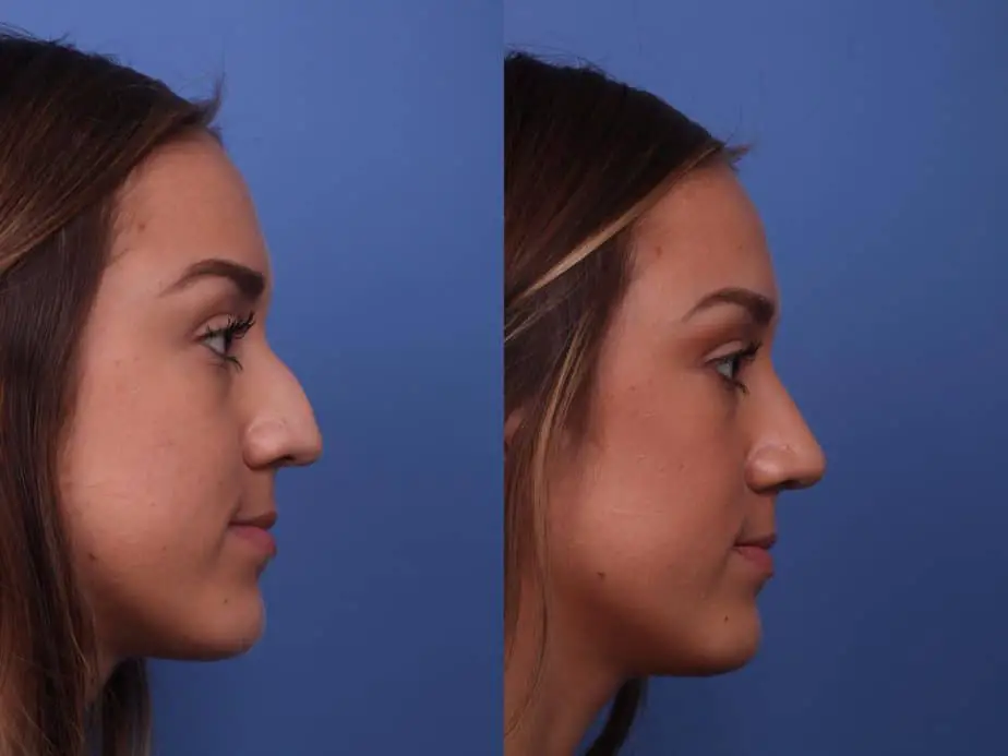 How Much Does A Nose Job Cost? Cost Niche