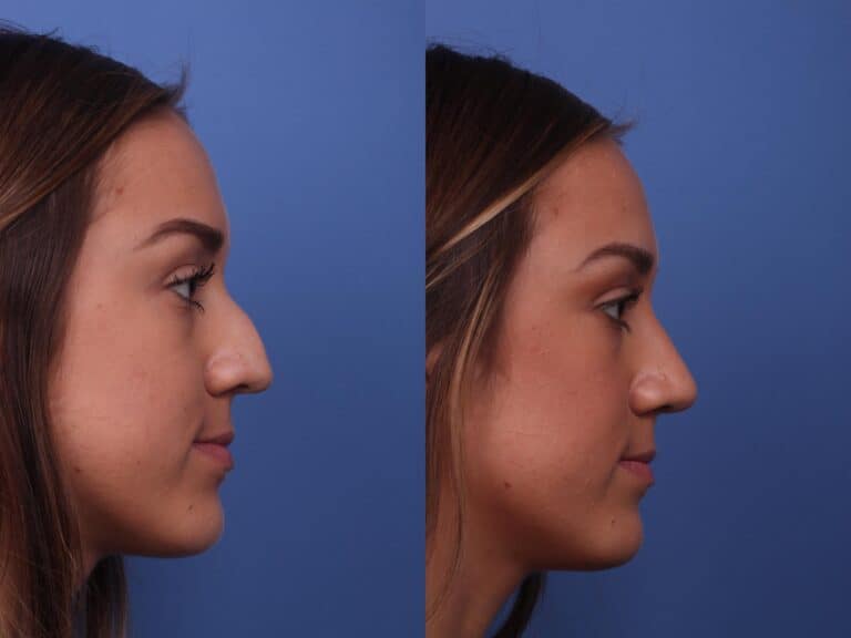 How Much Does A Nose Job Cost