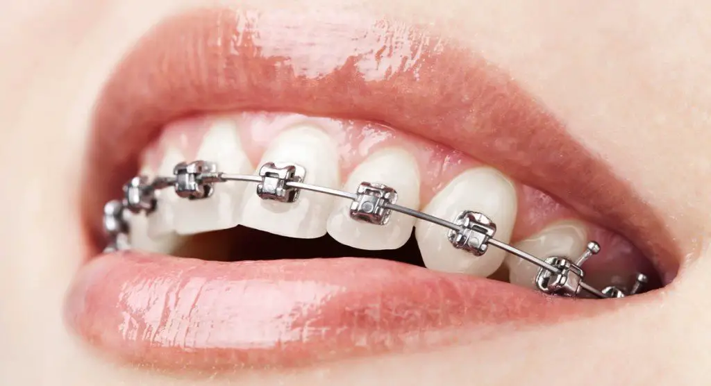 How Much Does It Cost To Get Braces